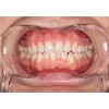 Ultradent - λευκανση - δοντια - KleerView Ενηλίκων KleerView - Παρειοκάτοχο 